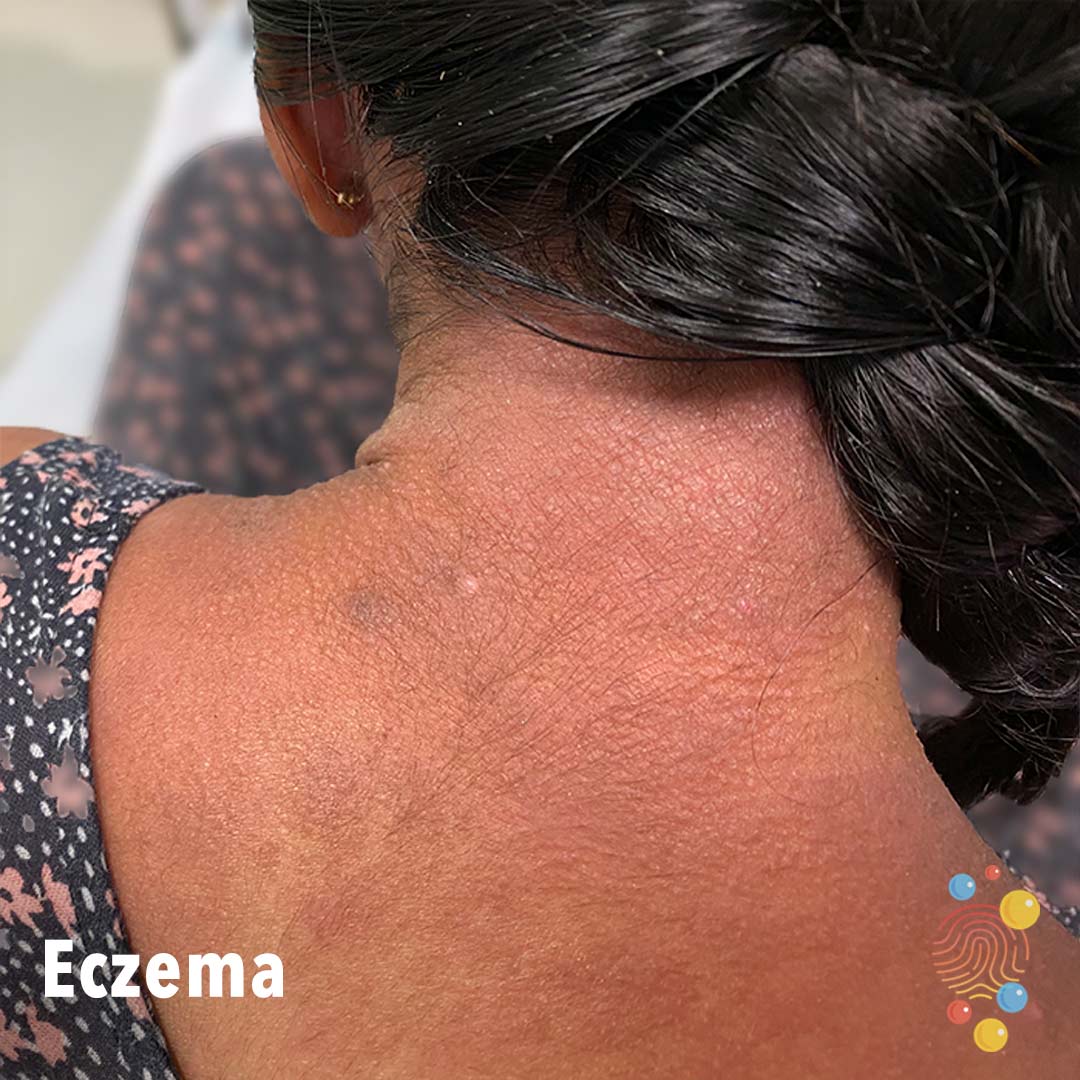 3-eczema.jpg
