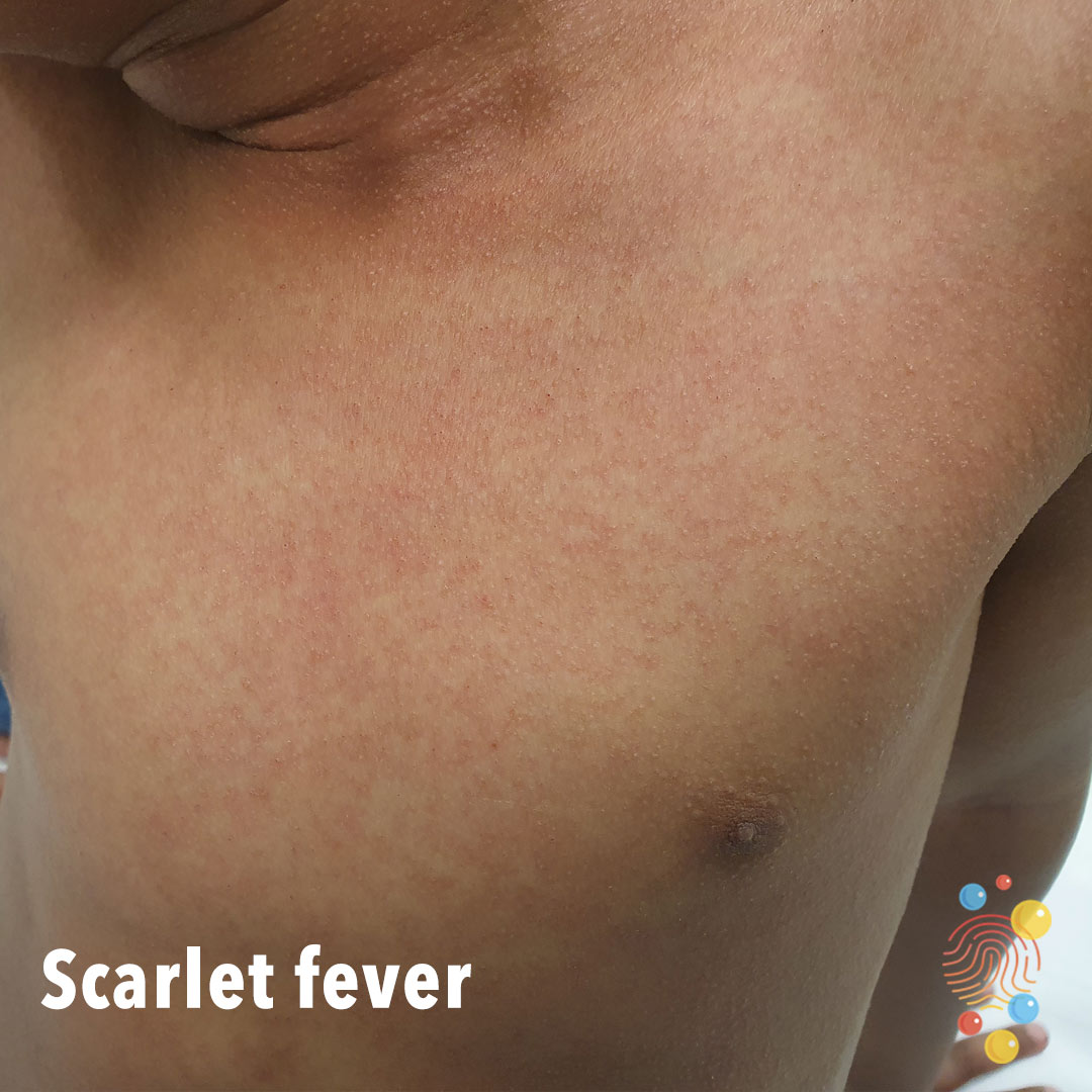 16a-scarlet-fever.jpg